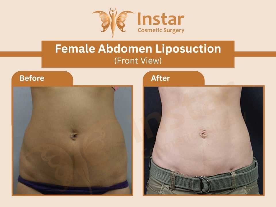Female Abdomen Liposuction (Front View)-1